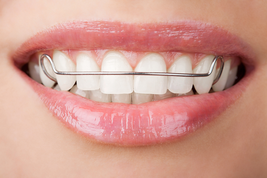 The Importance of Retainers in Las Vegas, NV: Maintaining Your Perfect Smile