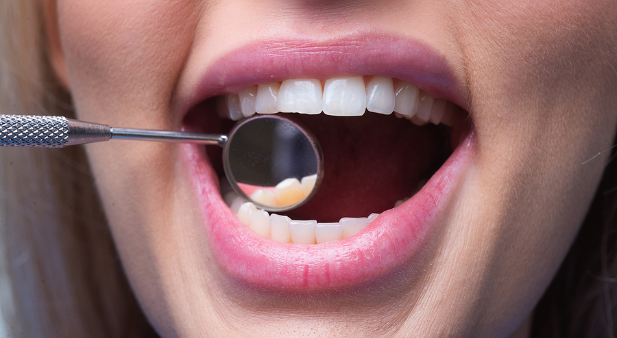 How Retainers Help Maintain Your Perfect Smile After Braces