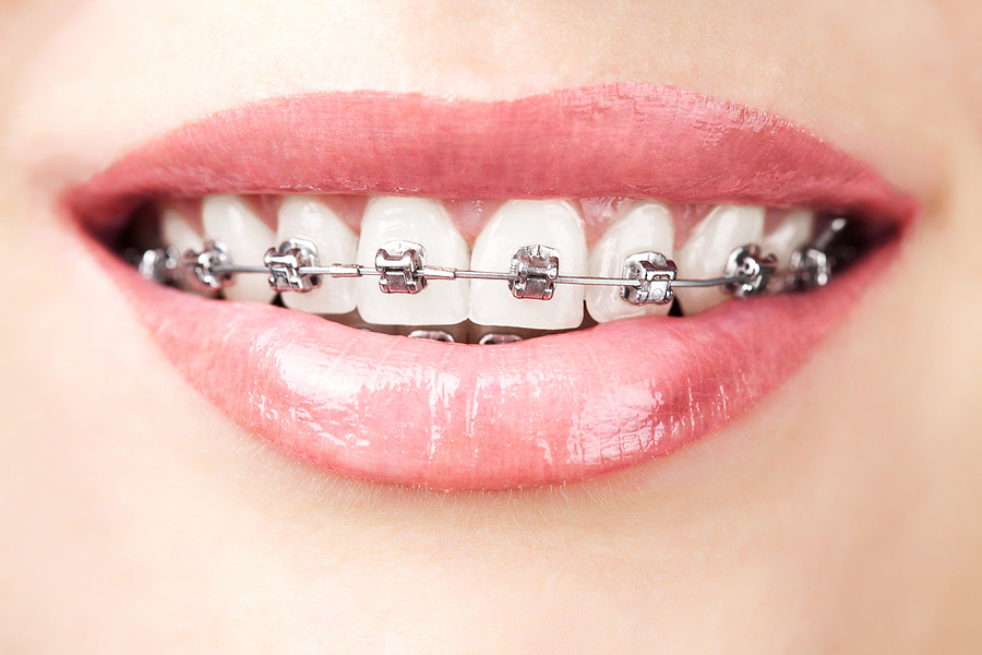 Everything You Need to Know About Traditional Braces