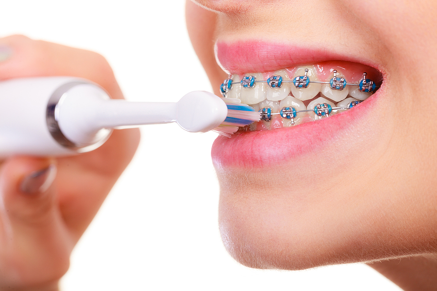 The Role of Dental Hygiene During Orthodontic Treatment – Don’t Skip It!