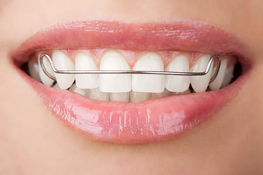 The Importance of Retainers in Las Vegas, NV: Maintaining Your Perfect Smile