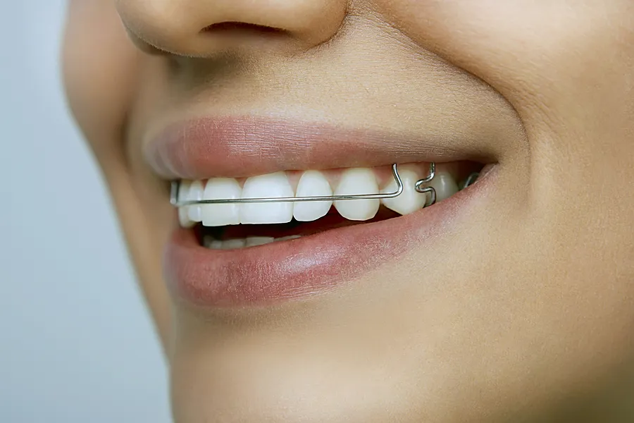 Everything You Need to Know About Retainers in Las Vegas, NV