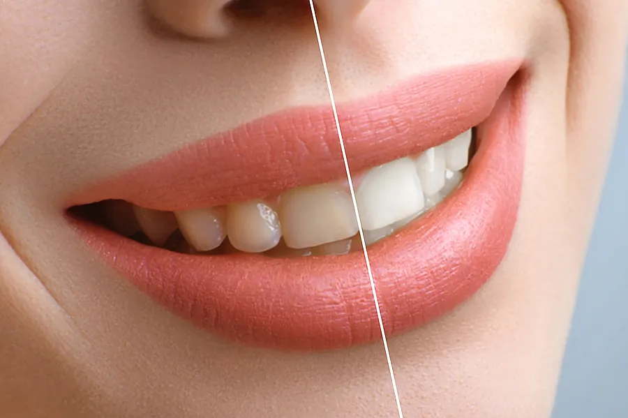 Achieve a Brighter Smile with Professional Teeth Whitening in Las Vegas, NV